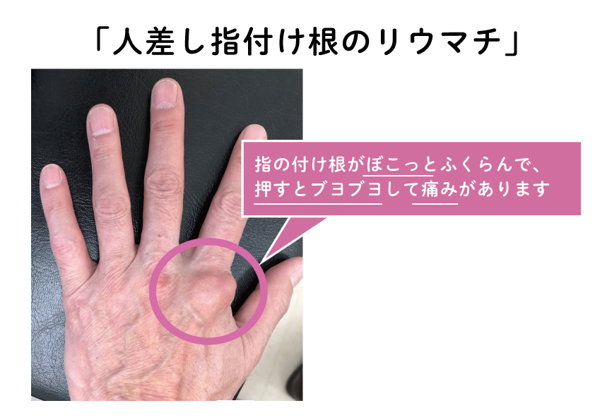 関節リウマチ手術は他にどこで使用される可能性がありますか?