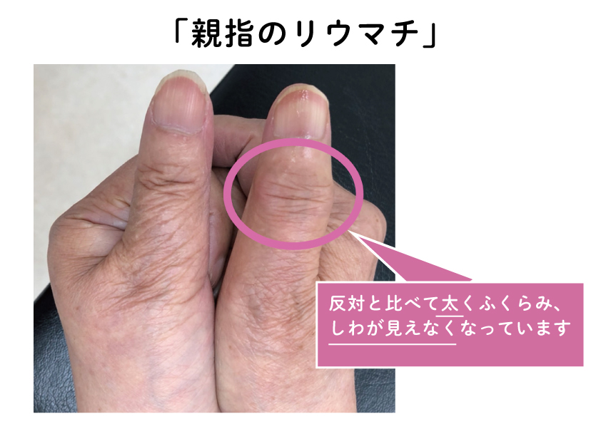 関節リウマチの発疹の治療法は何ですか?