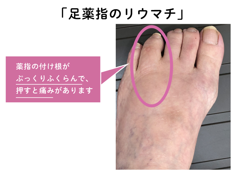 リンゴ酢の考えられる利点