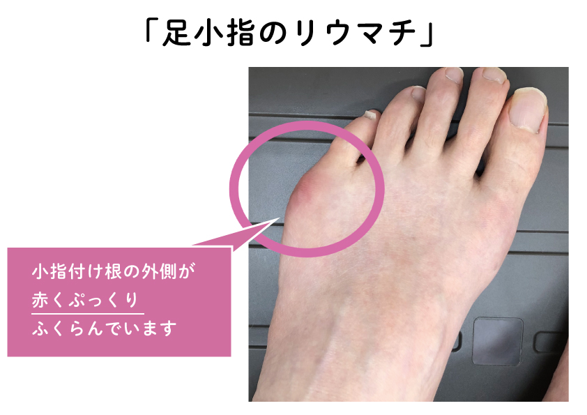 関節リウマチに対するその他の自然療法